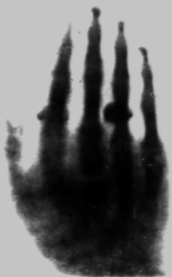 Pierwsze polskie zdjęcie rentgenowskie człowieka – ręka dr Tadeusza Estreichera