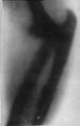 Pierwsze polskie zdjęcie rentgenowskie dla celów klinicznych – obraz zwichnięcia w stawie łokciowym 